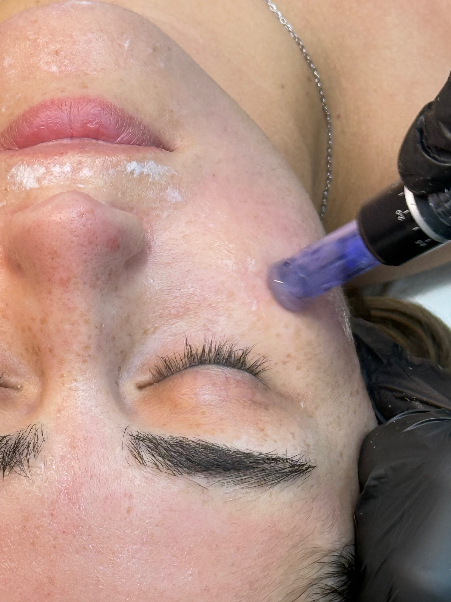 Collagen Rejuvenation Therapy