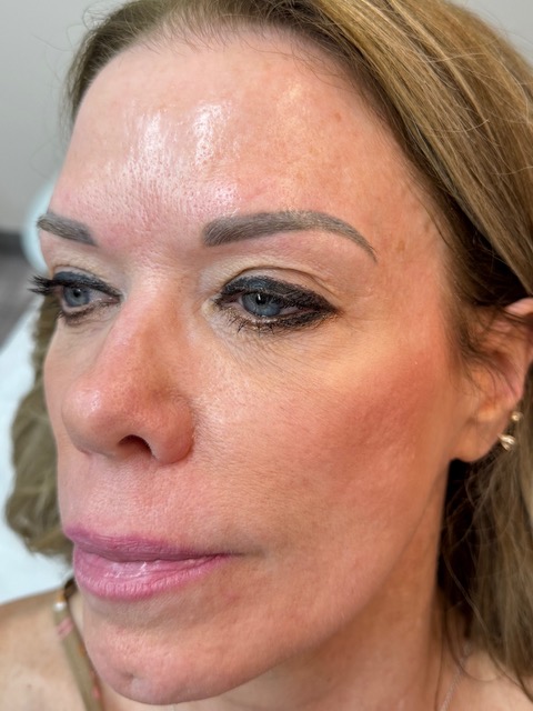 Skin Rejuvenation Before Treatment
